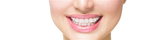 Clear Braces - Mariana Orthodontics