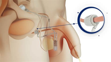 Urinary Incontinence - Artificial Urinary Sphincter Surgery
