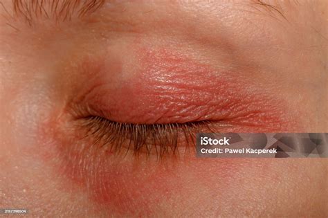 skin allergy red itchy  swollen eyelids close  stock photo