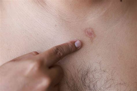 Stages of Pityriasis Rosea: Pictures and What to Know