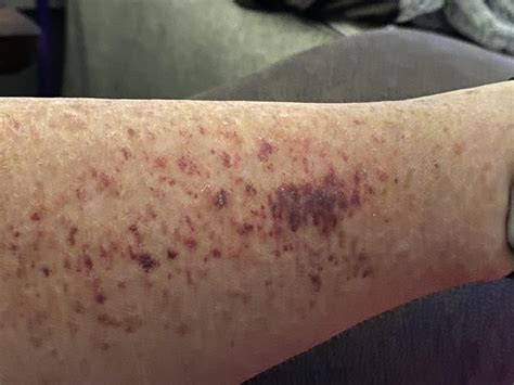 Xerolto and bleeding…anybody have little blood dots under skin