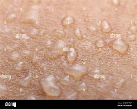 skin  blisters stock photo alamy