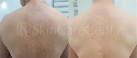 Laserska epilacija – SkinCare Centar