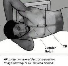 Lateral decubitus chest x-rays are helpful for determining effusions ...