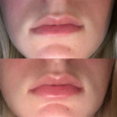 Best Lip Plumper Ever - Beauty Insider Community