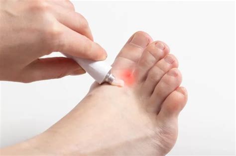 Clotrimazole vs Miconazole – Which Is Better For Yeast Infection ...