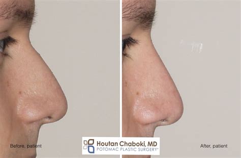 Augmentation Rhinoplasty without Breaking the Nose