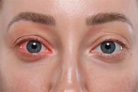 corner   eye red  veiny