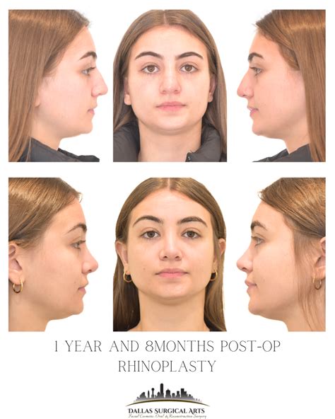 dallas rhinoplasty surgeon insights cost   rhinoplasty explained