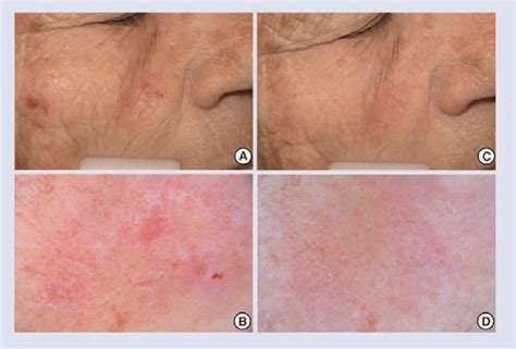 Dermoscopy in the treatment monitoring of actinic keratosis. (A ...