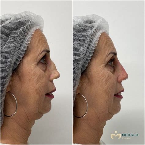 surgical rhinoplasty medglo clinic