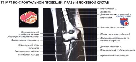 МРТ локтевого сустава во фронтальной проекции в норме