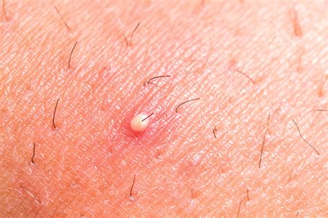 Ingrown Hair: What Is It and How to Prevent This Problem?