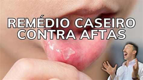 Como Acaba Com Afta - Melhores Remedios Para Afta - RETOEDU