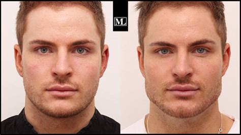Hyaluronbehandlung für den Mann | Mascu Look | Dr. Djalaei