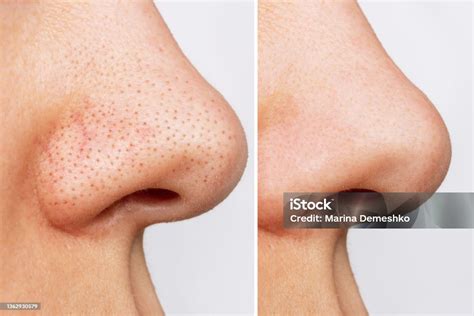 Como Tirar Pontos Pretos Do Nariz - Foto de Closeup Do Nariz Da Mulher Com Cravos Ou Pontos Pretos Antes E ...