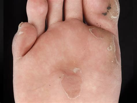 Epidermolysis Bullosa Dermnet Nz
