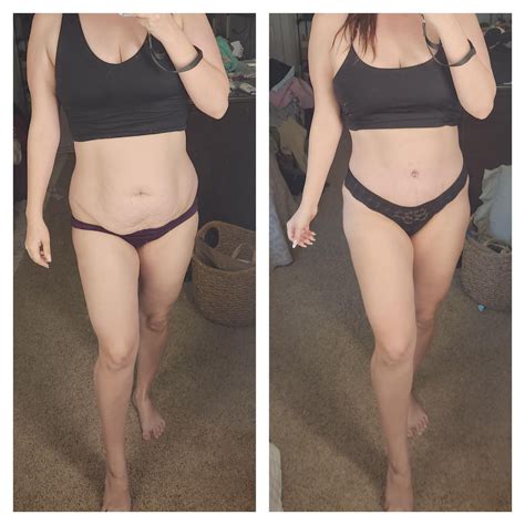 2 week post update! Holy SMOKES😍 : r/tummytucksurgery