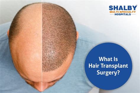 important tips  recovery  hair transplant shalby