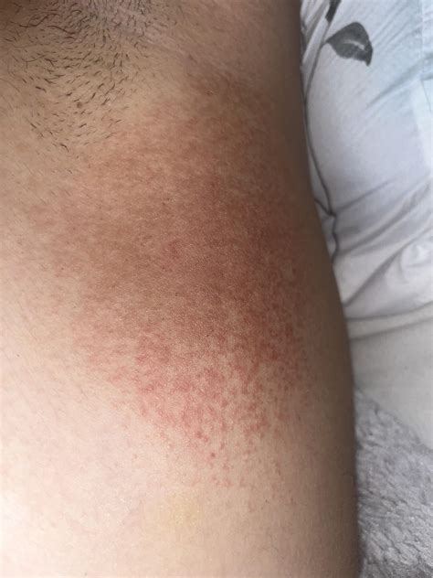 Rash : r/DermatologyQuestions