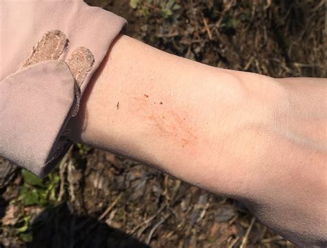 Ожог от борщевика. Весной и летом одним цветом.