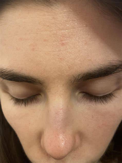 Elidel (Pimecrolimus cream) ruined my skin?? Is it possible? Please