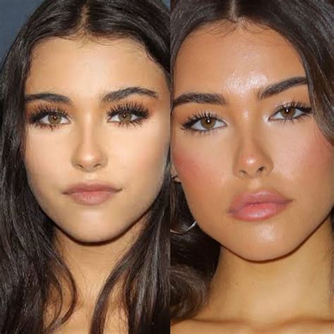 Madison Beer Lip Injections – Madison Beer Surgery – AKMWUW
