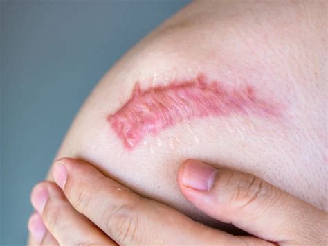 penyakit keloid homecare