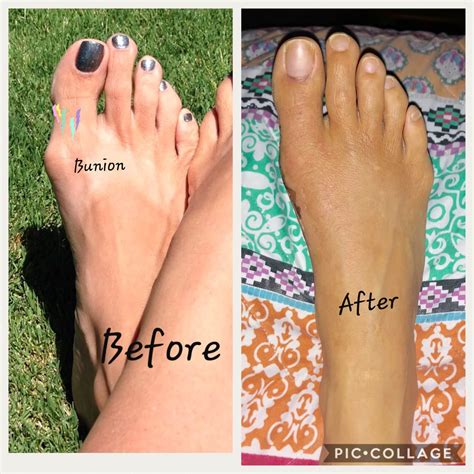 Foot Discoloration After Bunion Surgery at Colby Westlake blog