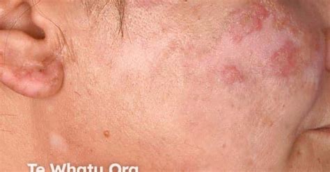 Discoid lupus erythematosus image