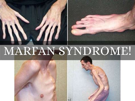 Wilson's Disease: 10 Wilson's Disease Symptoms