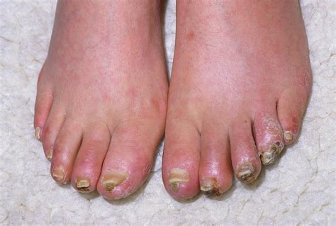 What Does Gangrene Look Like On The Foot Discount | emergencydentistry.com