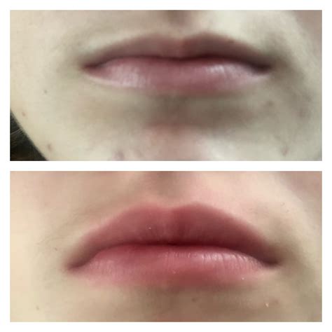 How Does Needle Free Lip Filler Work at Jada Avitia blog