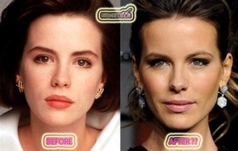 Kate Beckinsale Nose Job | Nose job, Nose surgery, Celebrity plastic ...