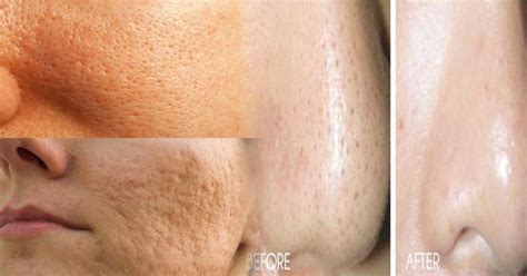 how to rid open pores