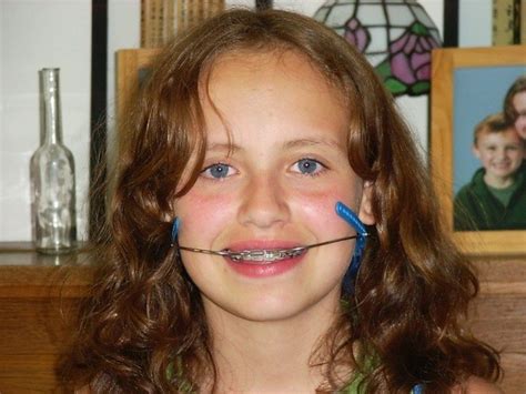 How Headgear Braces Can Help Improve Your Child's Smile