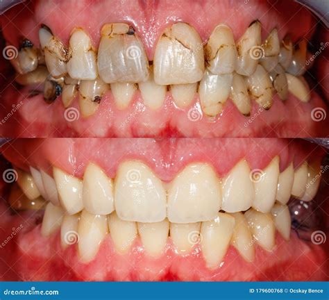 Dentes De Fumantes Antes E Depois - Dentes Antes E Depois Do Tratamento Foto de Stock - Imagem de médico ...