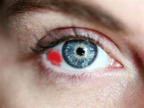 Por Que Se Hace Un Derrame En El Ojo Consejos Ojos | My XXX Hot Girl
