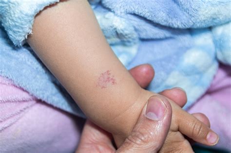 Hemangioma No Braço - Foto de Angioma Ou Hemangioma Rosa No Braço De Um Bebê De Quinze Meses ...