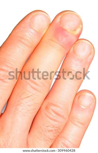 Hand Finger Infection Detail Stock Photo 309960428 | Shutterstock