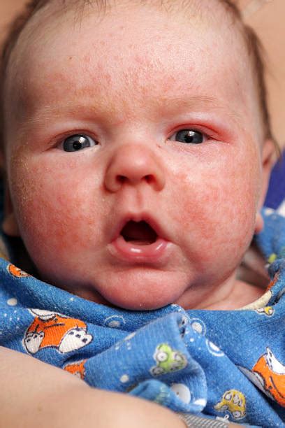 Allergic Diathesis Stock Photos, Pictures & Royalty-Free Images - iStock