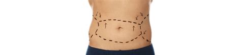 tummy tucks  procedure costs  financing options lendingusa