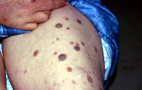 BACTERIAL INFECTIONS - Hansen disease picture | Hellenic Dermatological ...
