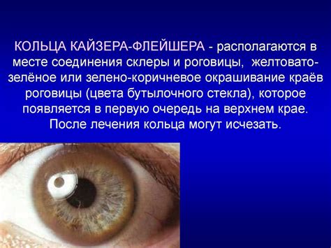 Гепатолентикулярная дегенерация (Болезнь Вильсона-Коновалова ...
