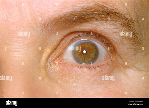 The left eye of a patient showing the effects of abnormally high levels of cholesterol in the ...