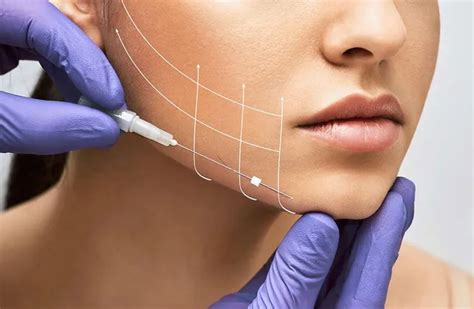 neck thread lift   benefits  risks