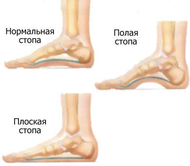 Лечение плоскостопия у детей и взрослых в Одессе