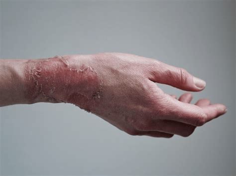 356 Boil Scar Treatment Royalty-Free Images, Stock Photos & Pictures ...