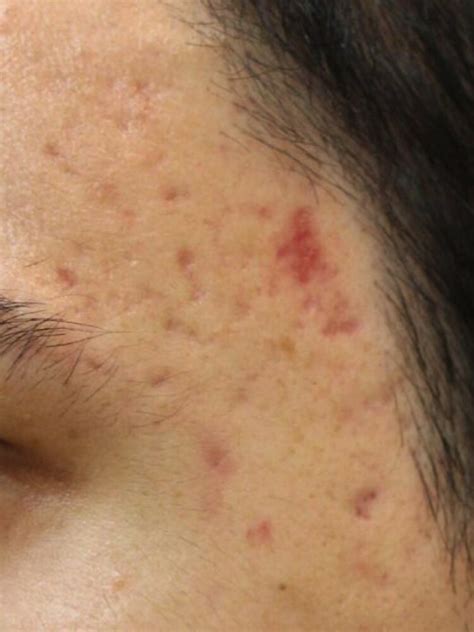 acne scar treatment removal brisbane skin