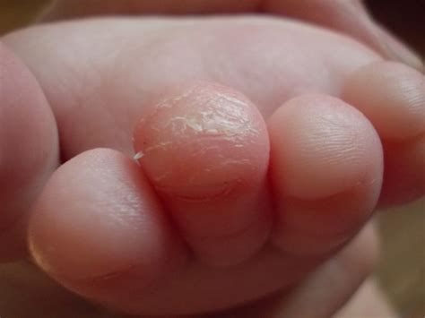 Лечение грибка ног у ребенка на пальцах и между ними